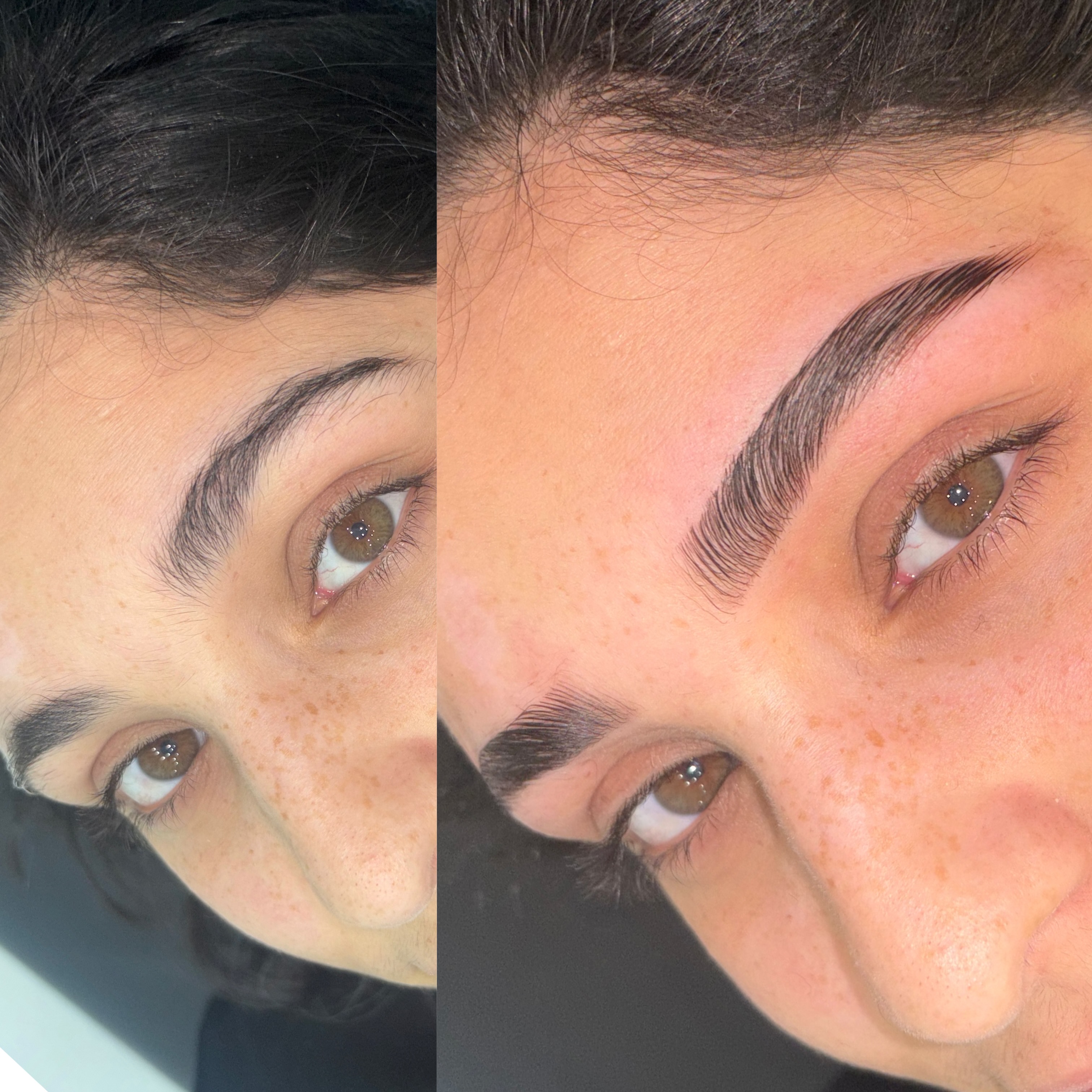 browlift
